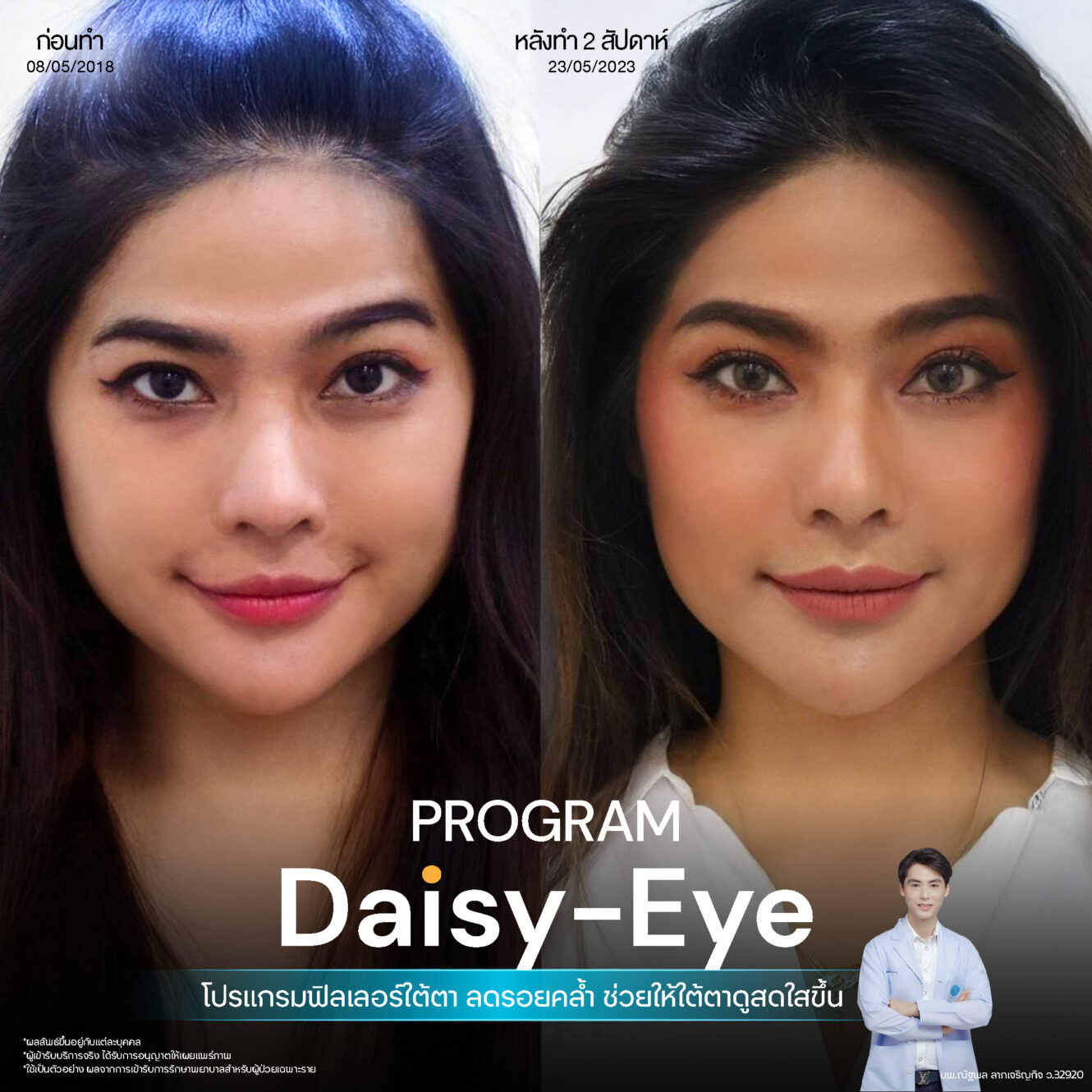 Filler ใต้ตา 15