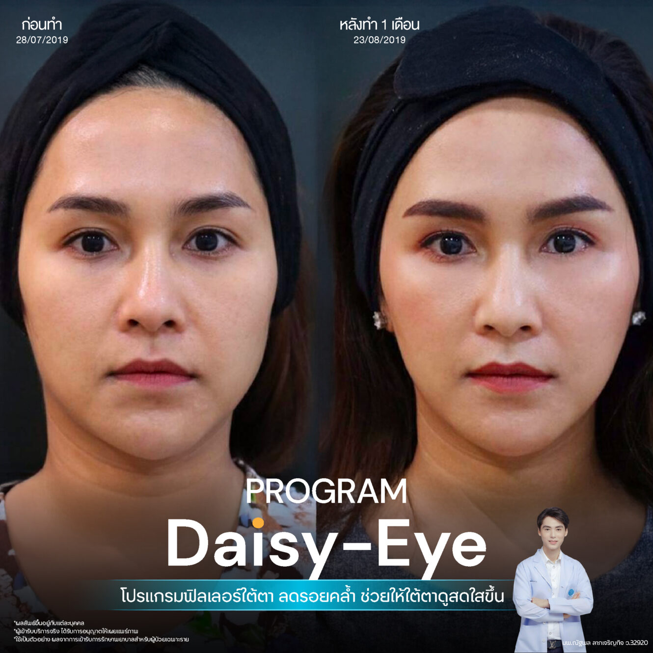 Filler ใต้ตา 17