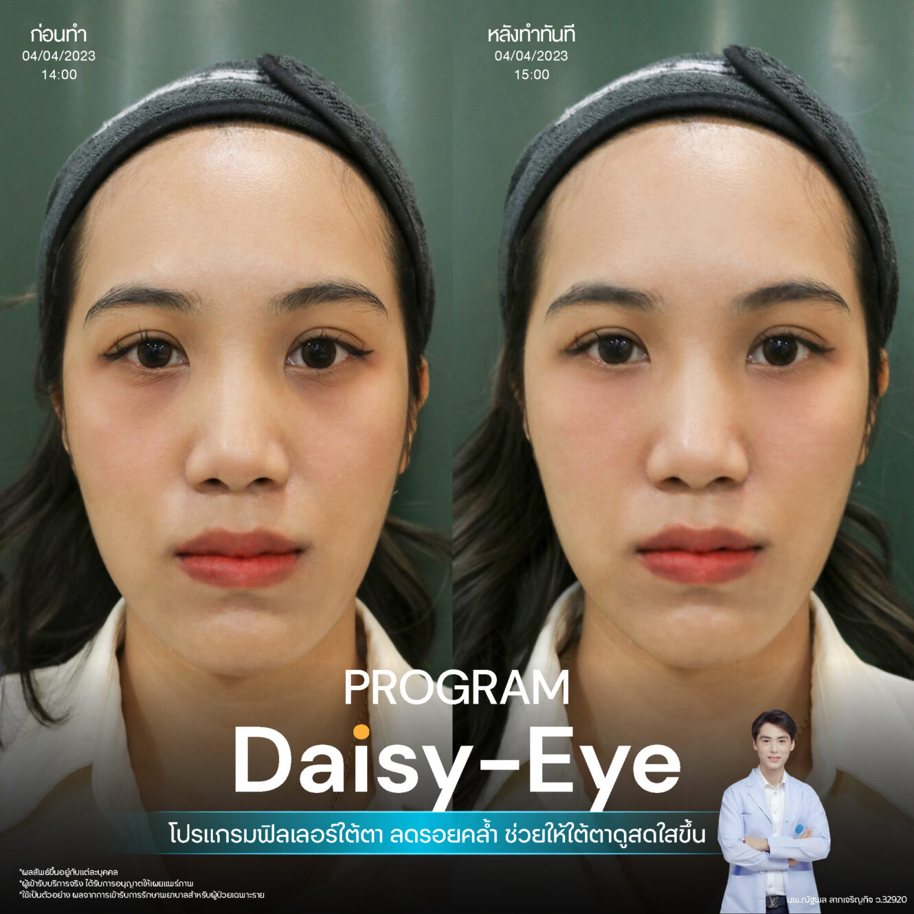 Filler ใต้ตา 18