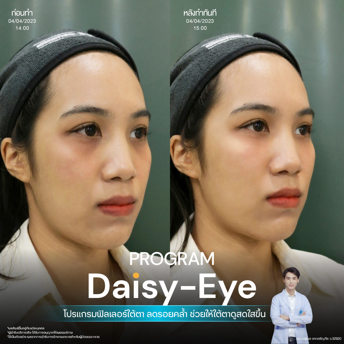 Filler ใต้ตา 19