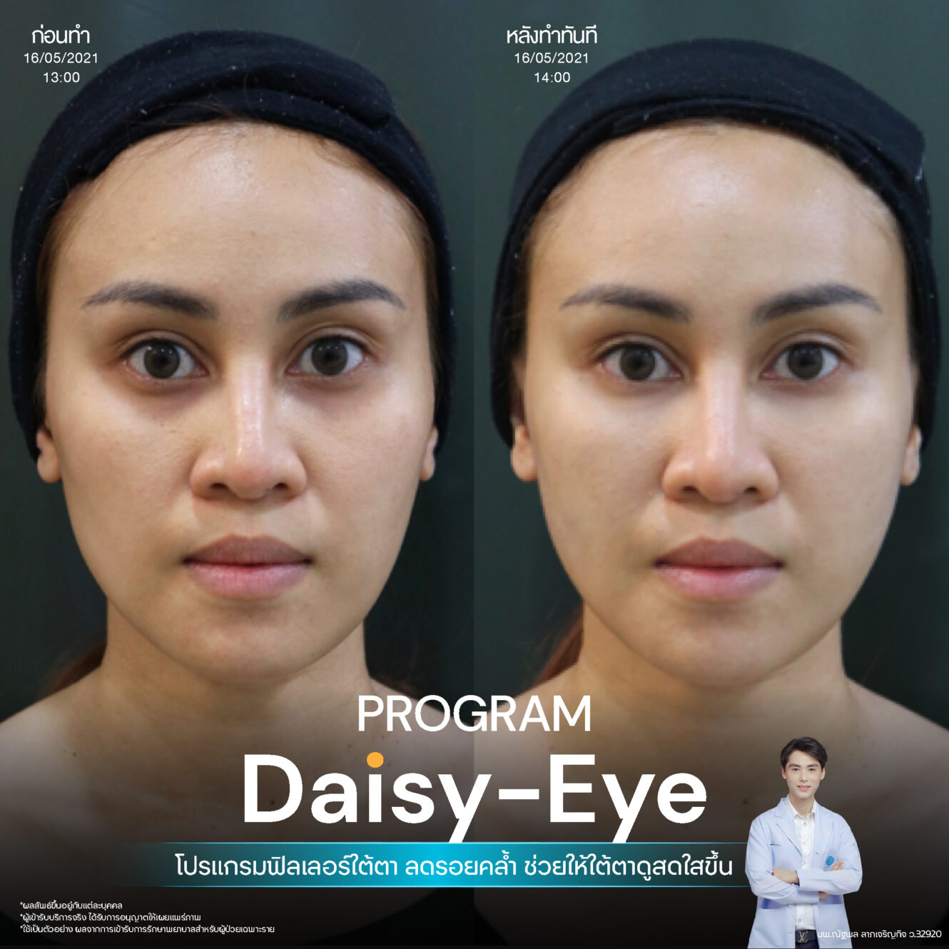 Filler ใต้ตา 21