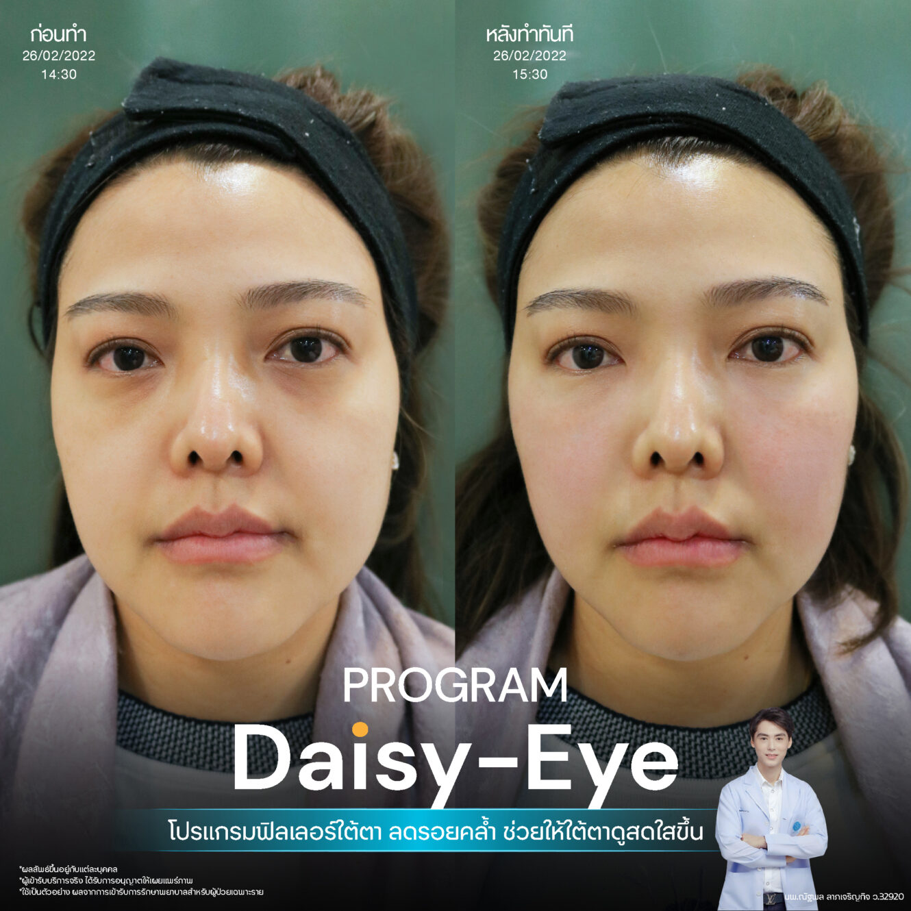 Filler ใต้ตา 22