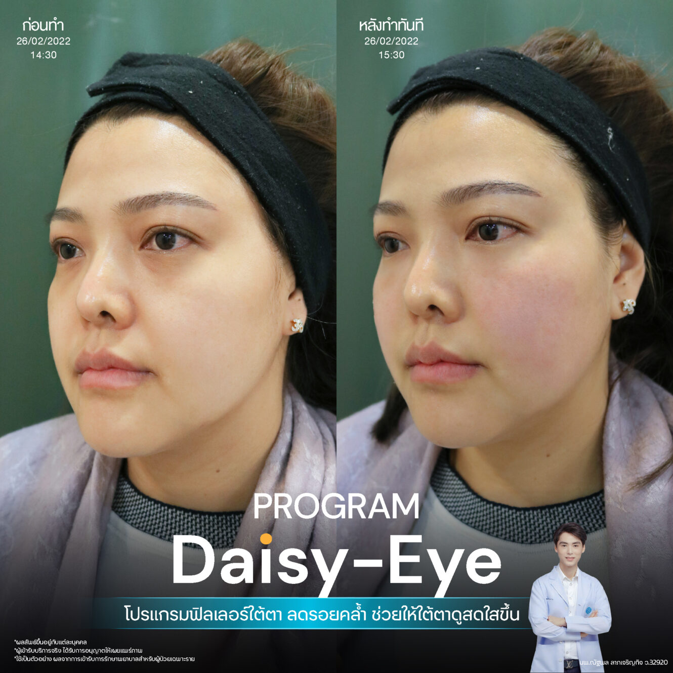 Filler ใต้ตา 23