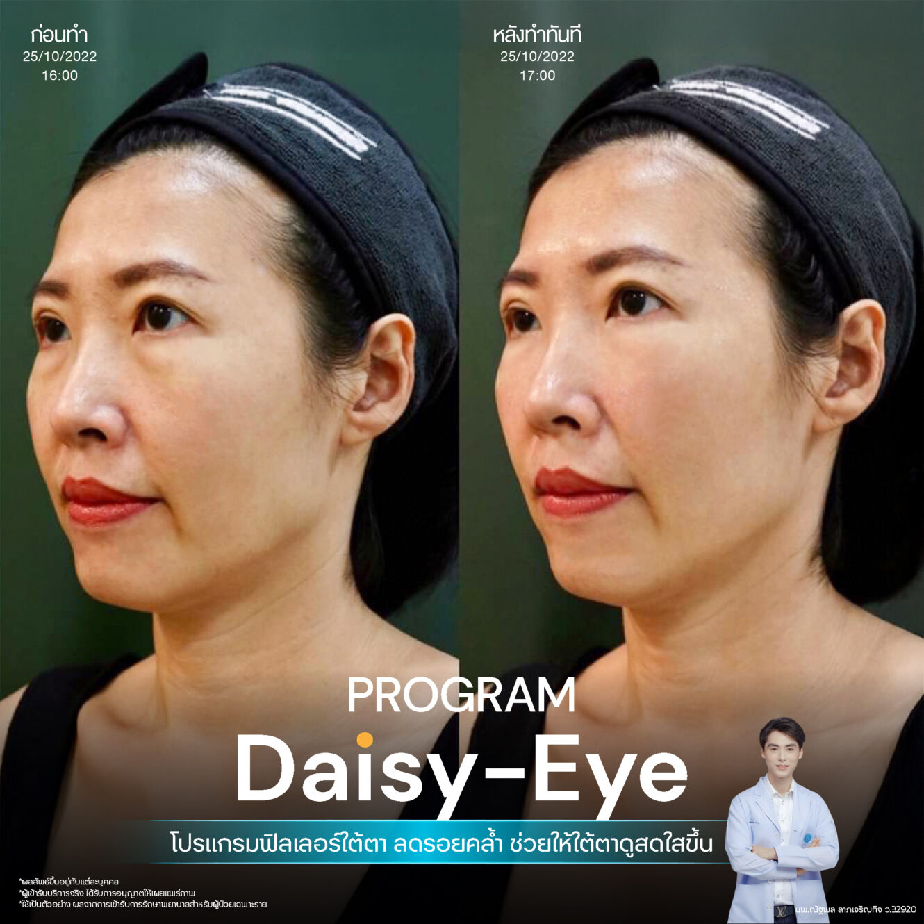 Filler ใต้ตา 25