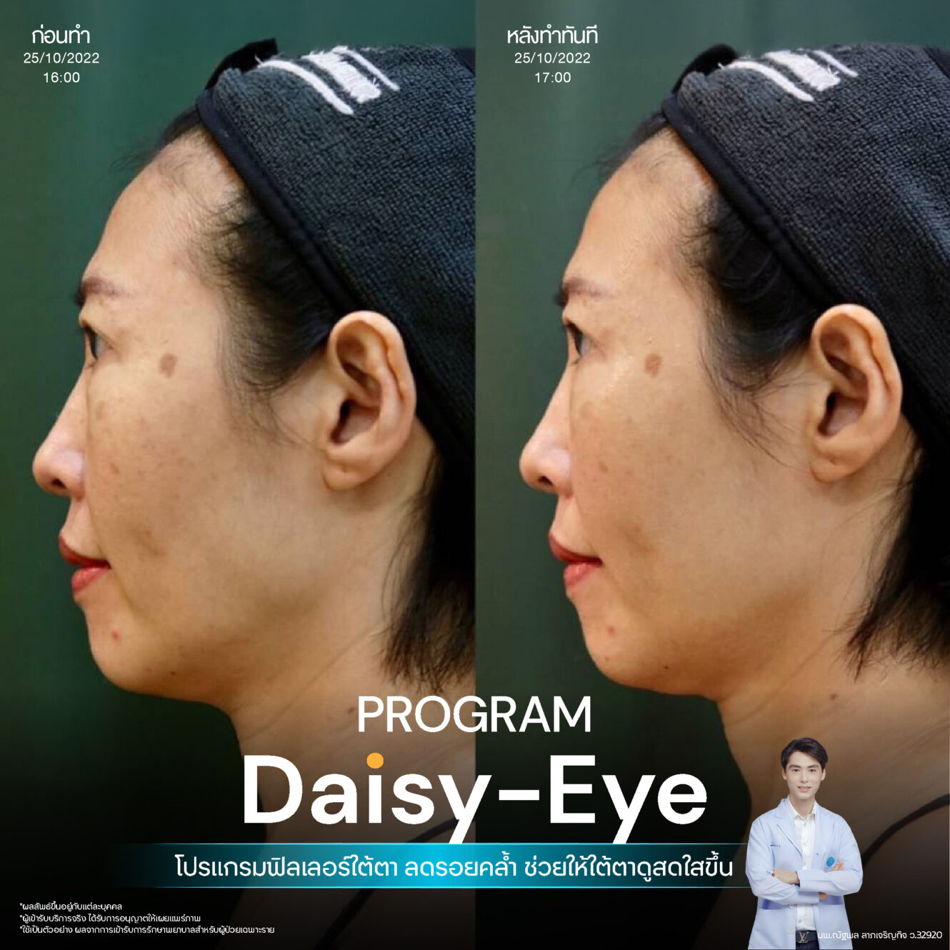 Filler ใต้ตา 26