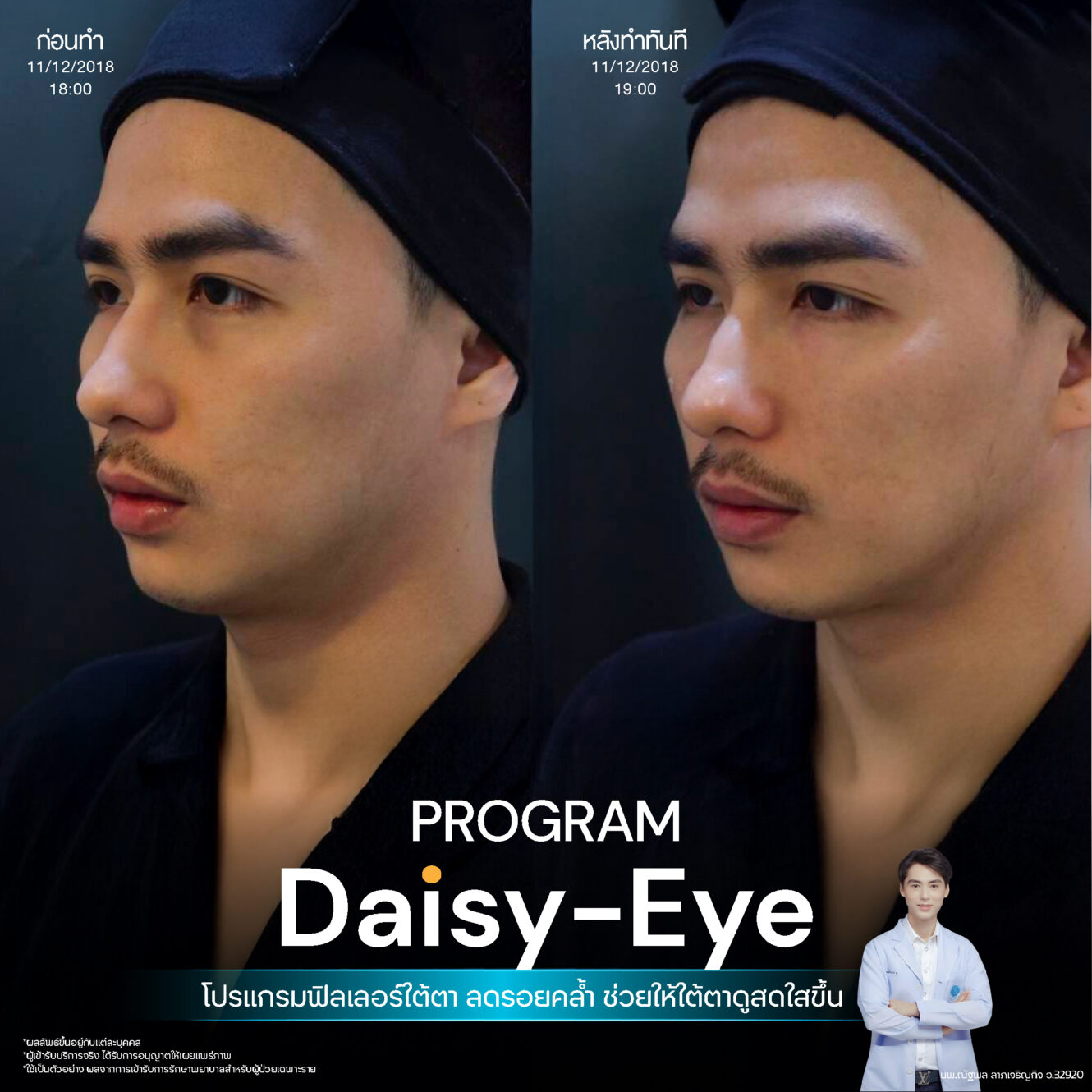 Filler ใต้ตา 27