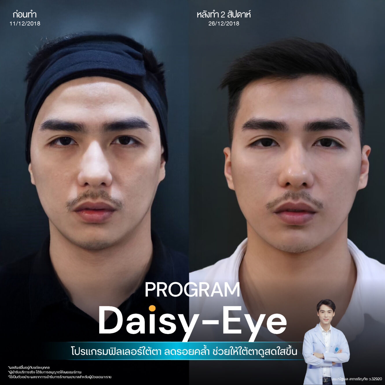 Filler ใต้ตา 28