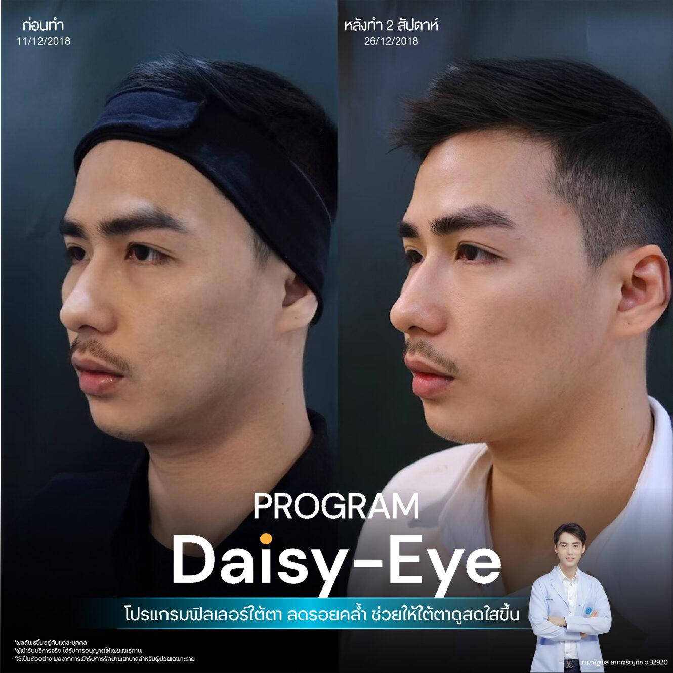 โปรแกรม Restylane Vital Light ลดริ้วรอยและร่องลึกใต้ตา 12 Filler ใต้ตา 29