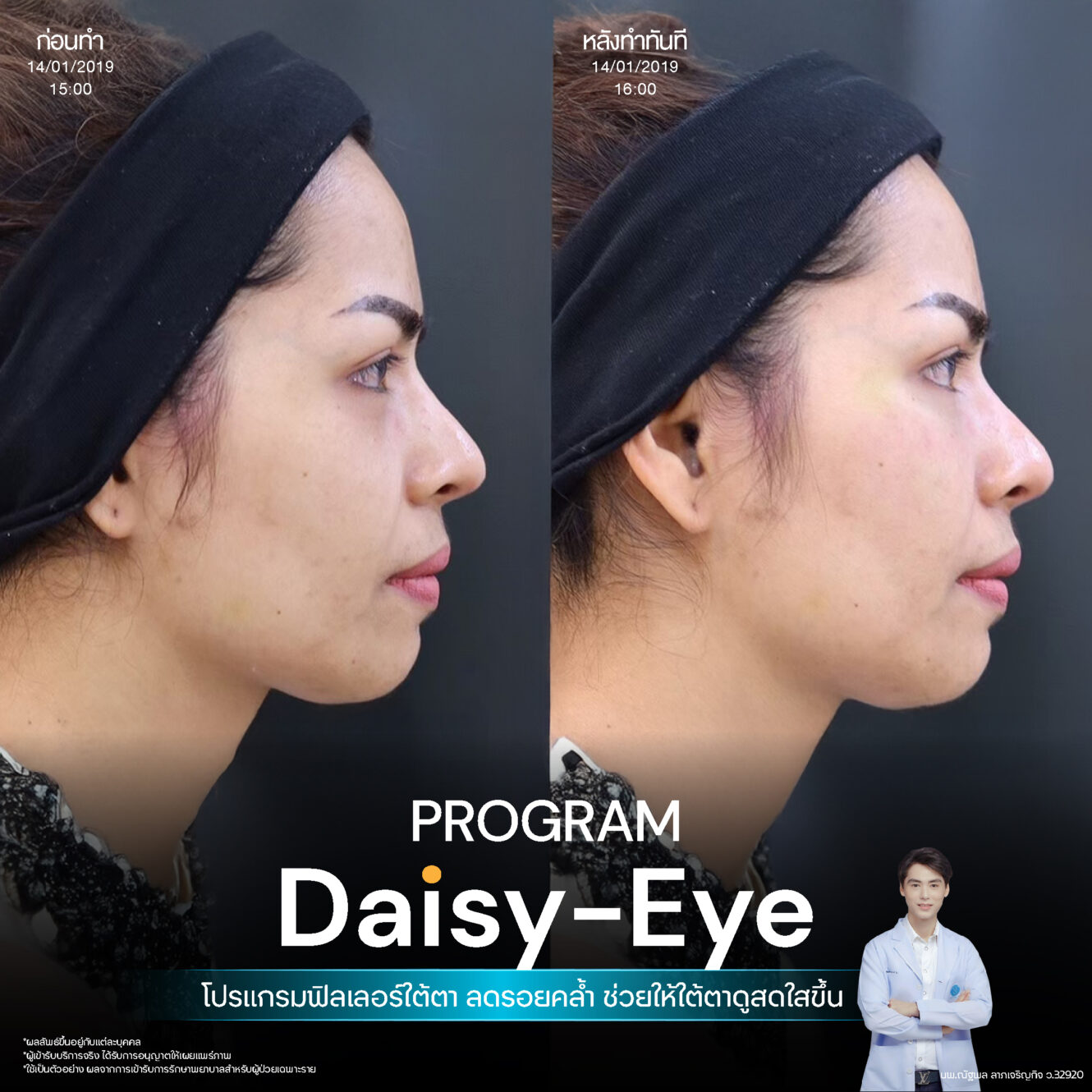 โปรแกรม Restylane Vital Light ลดริ้วรอยและร่องลึกใต้ตา 9 Filler ใต้ตา 30