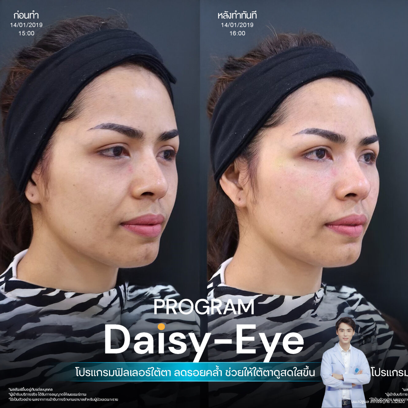 Filler ใต้ตา 31