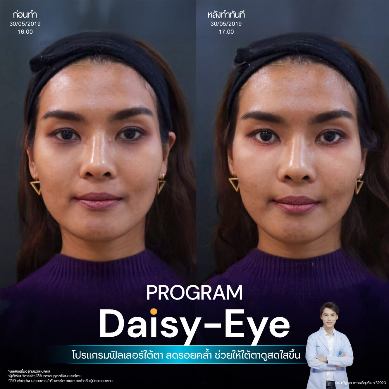 Filler ใต้ตา 33