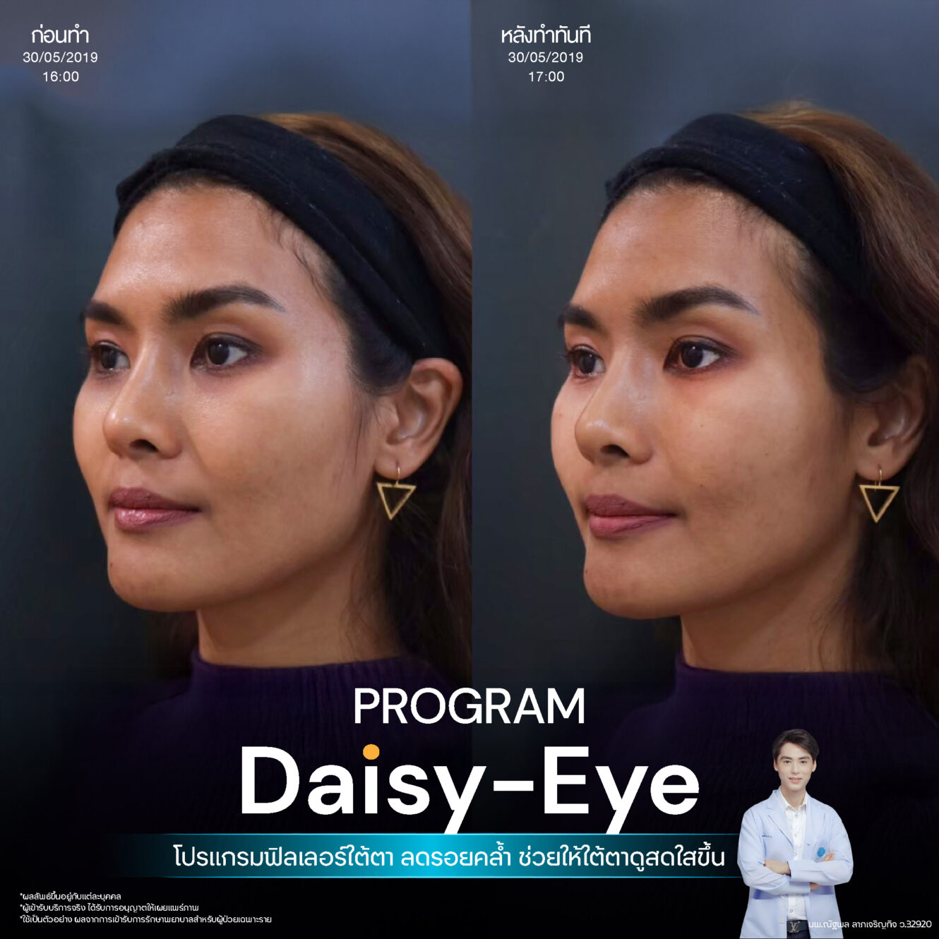 Filler ใต้ตา 34