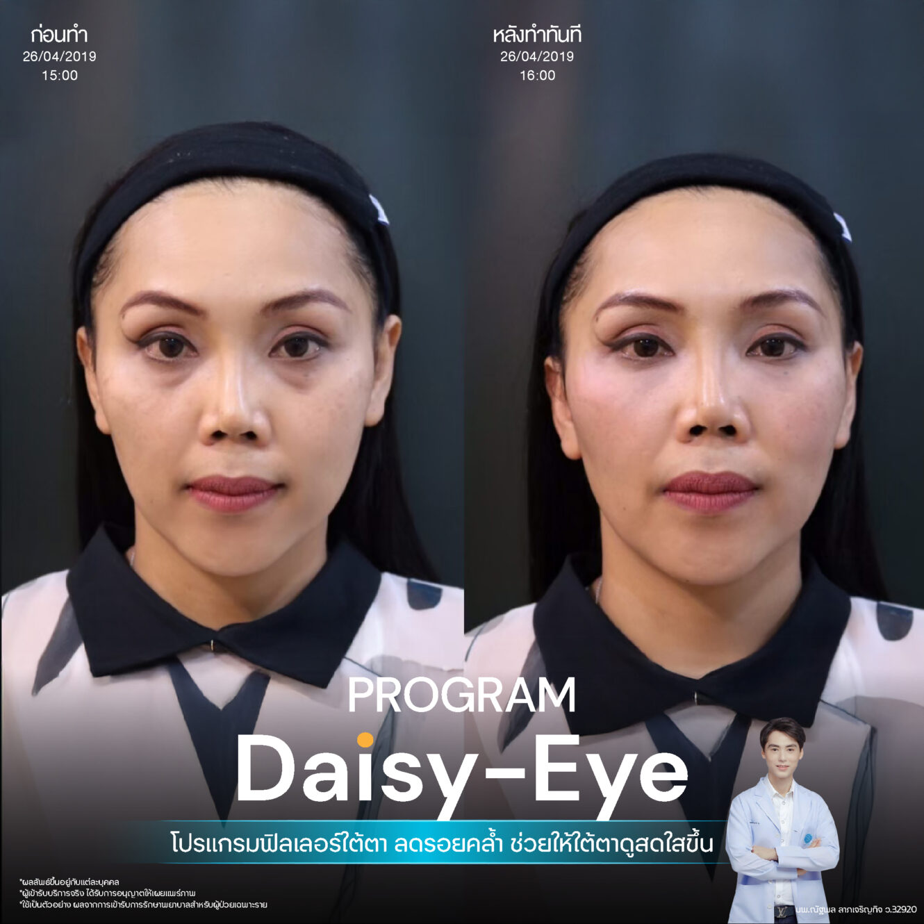 Filler ใต้ตา 35