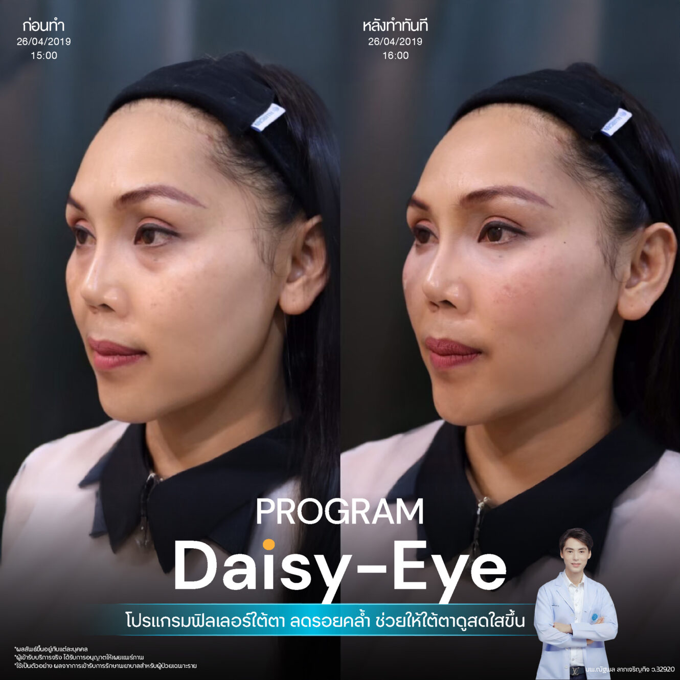 Filler ใต้ตา 36