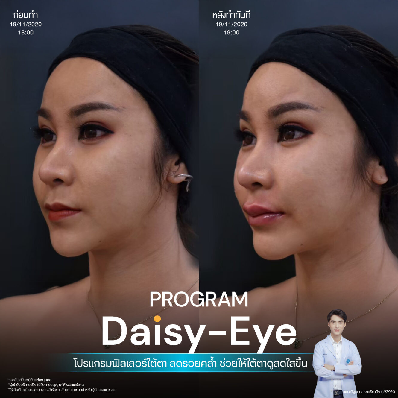 Filler ใต้ตา 38