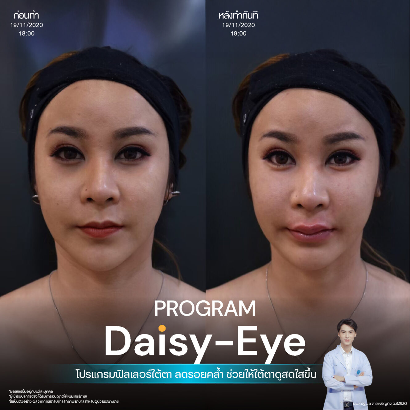 Filler ใต้ตา 39