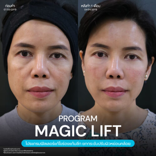 Magic Lift 27