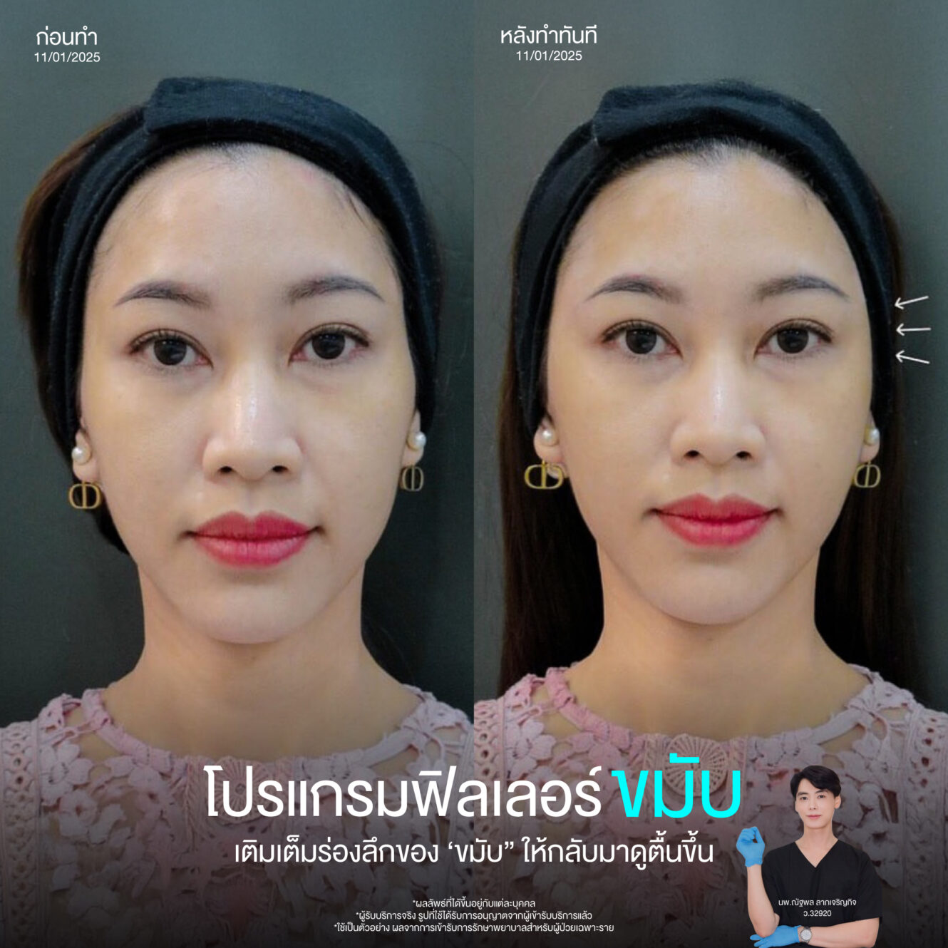 โปรแกรมฉีดฟิลเลอร์หน้าผาก เติมเต็มความอ่อนเยาว์และลดเลือดริ้วรอย 4 Web Sep 25 08