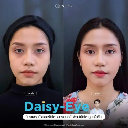 โปรแกรมฟิลเลอร์ (Filler) คืออะไร? ดีจริงไหม มีอะไรที่ควรรู้ก่อนฉีดบ้าง 2 ฟิลเลอร์ คือ