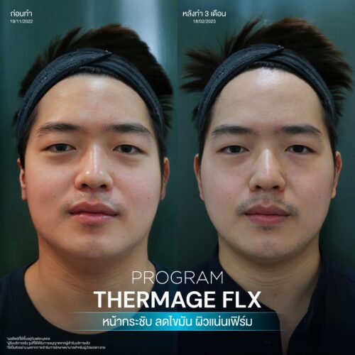 BA Thermage 07