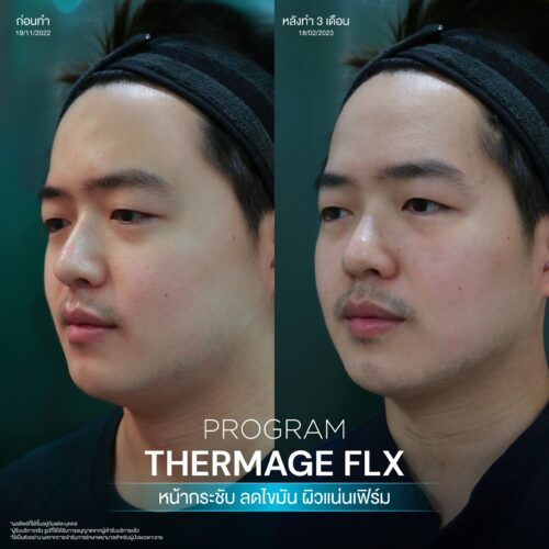 BA Thermage 08