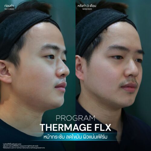 BA Thermage 09