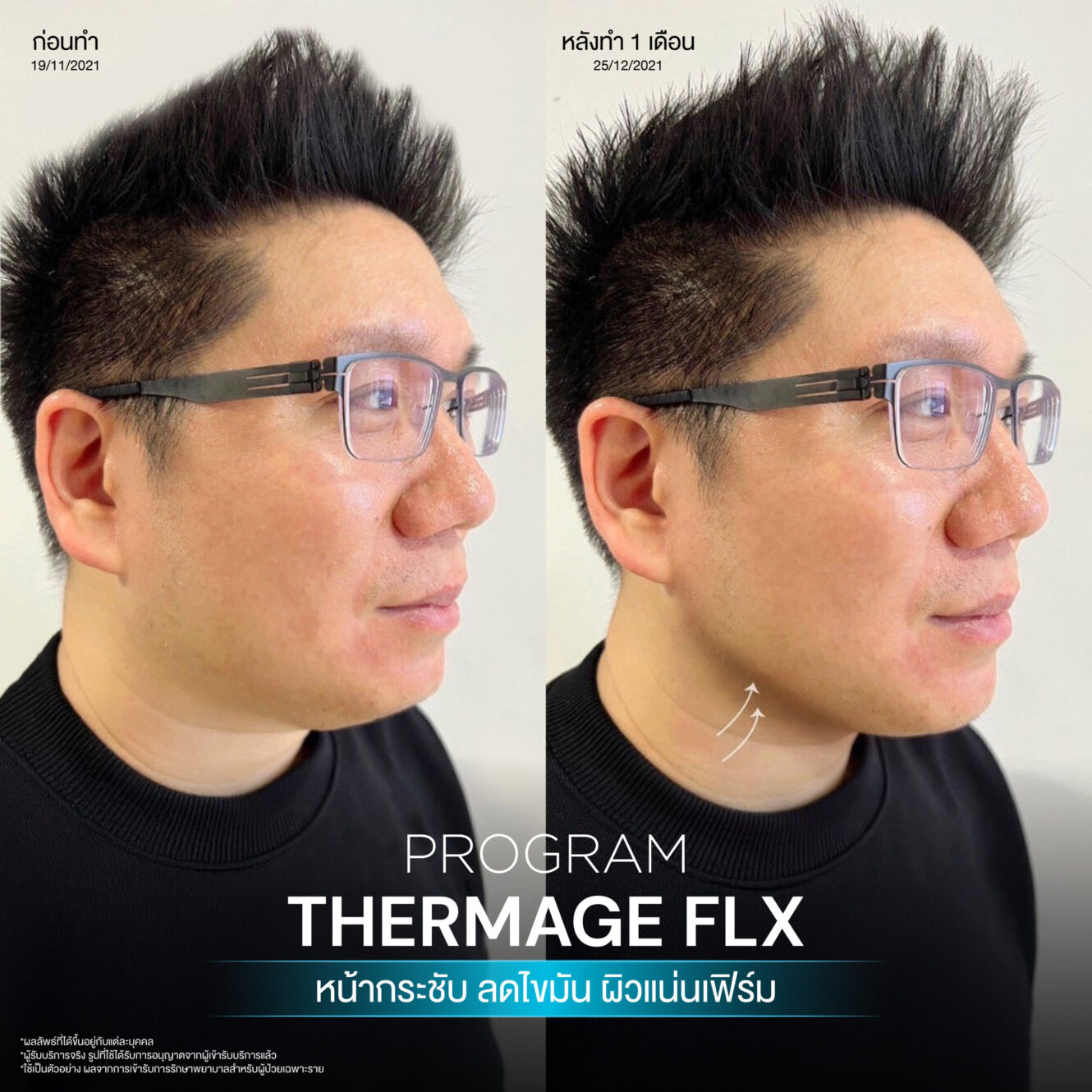 BA Thermage 11