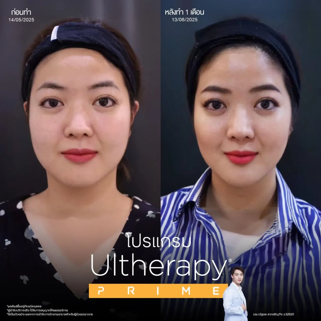 โปรแกรม Ulthera เจ็บไหม? ก่อนเลือกยกกระชับต้องรู้ 4 หลังทํา Ulthera