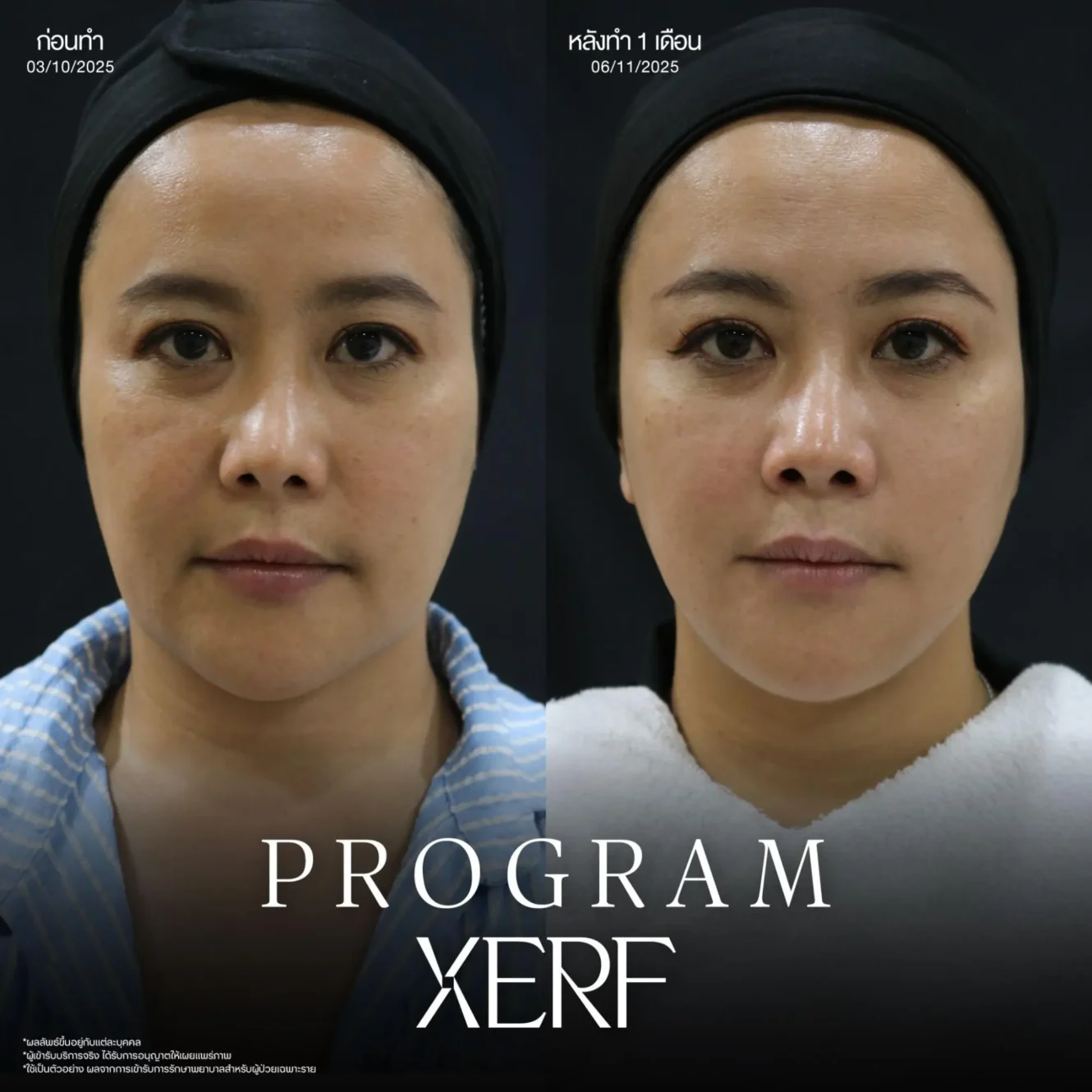 โปรแกรม XERF หัตถการยกกระชับล่าสุด เหมาะกับใคร ดีกว่าเครื่องอื่นยังไง? 4 ขั้นตอน XERF