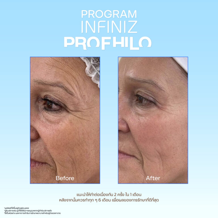 Profhilo sale kit 06