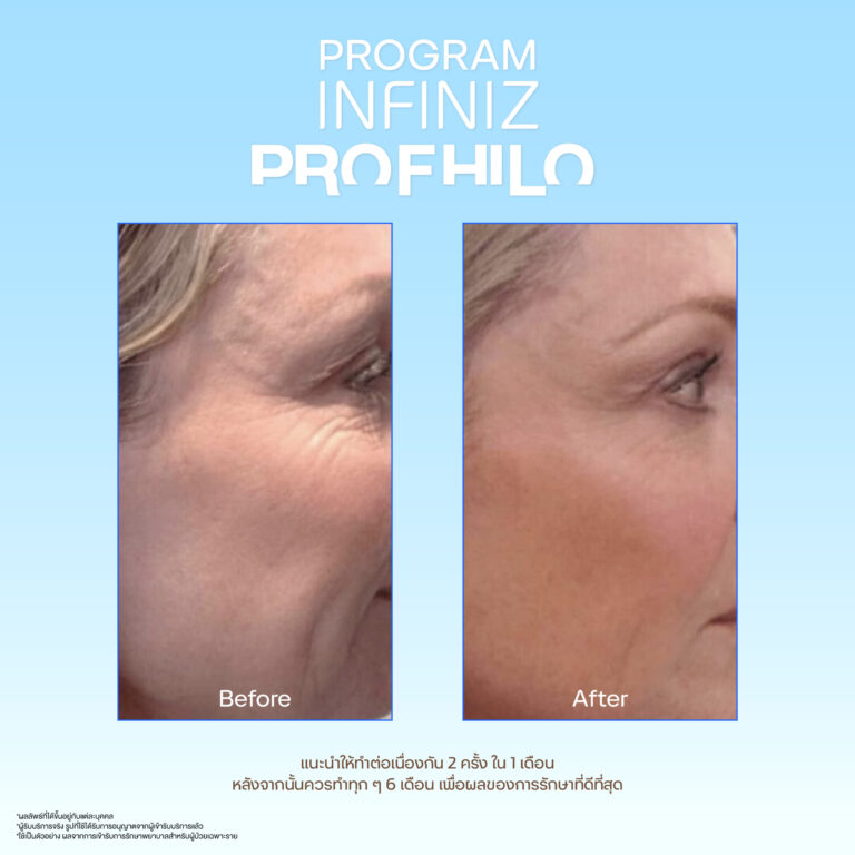 Profhilo sale kit 08