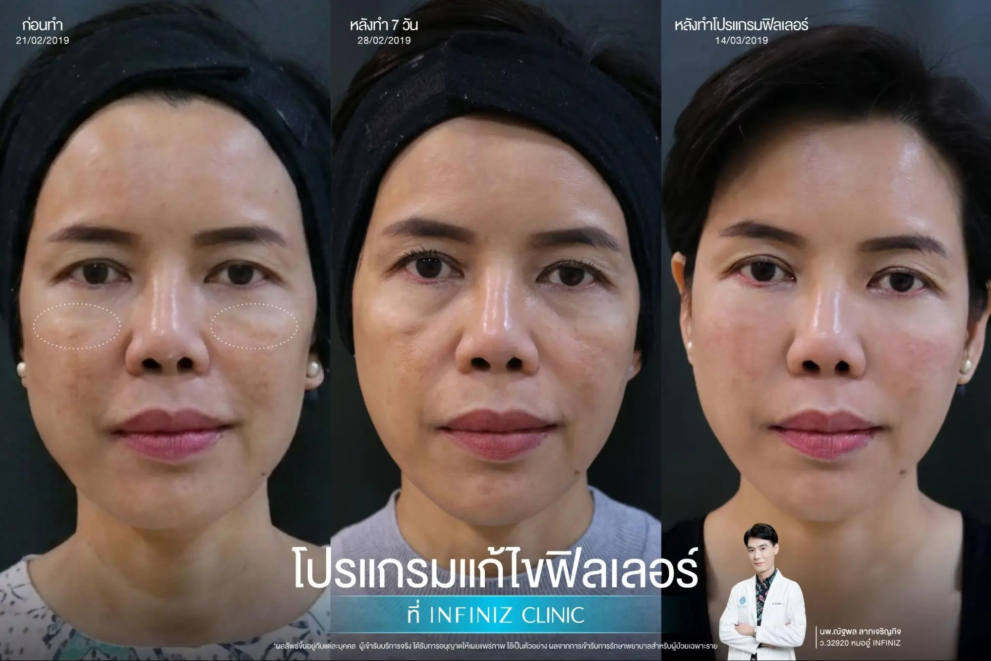 โปรแกรมสลายฟิลเลอร์ผลข้างเคียง