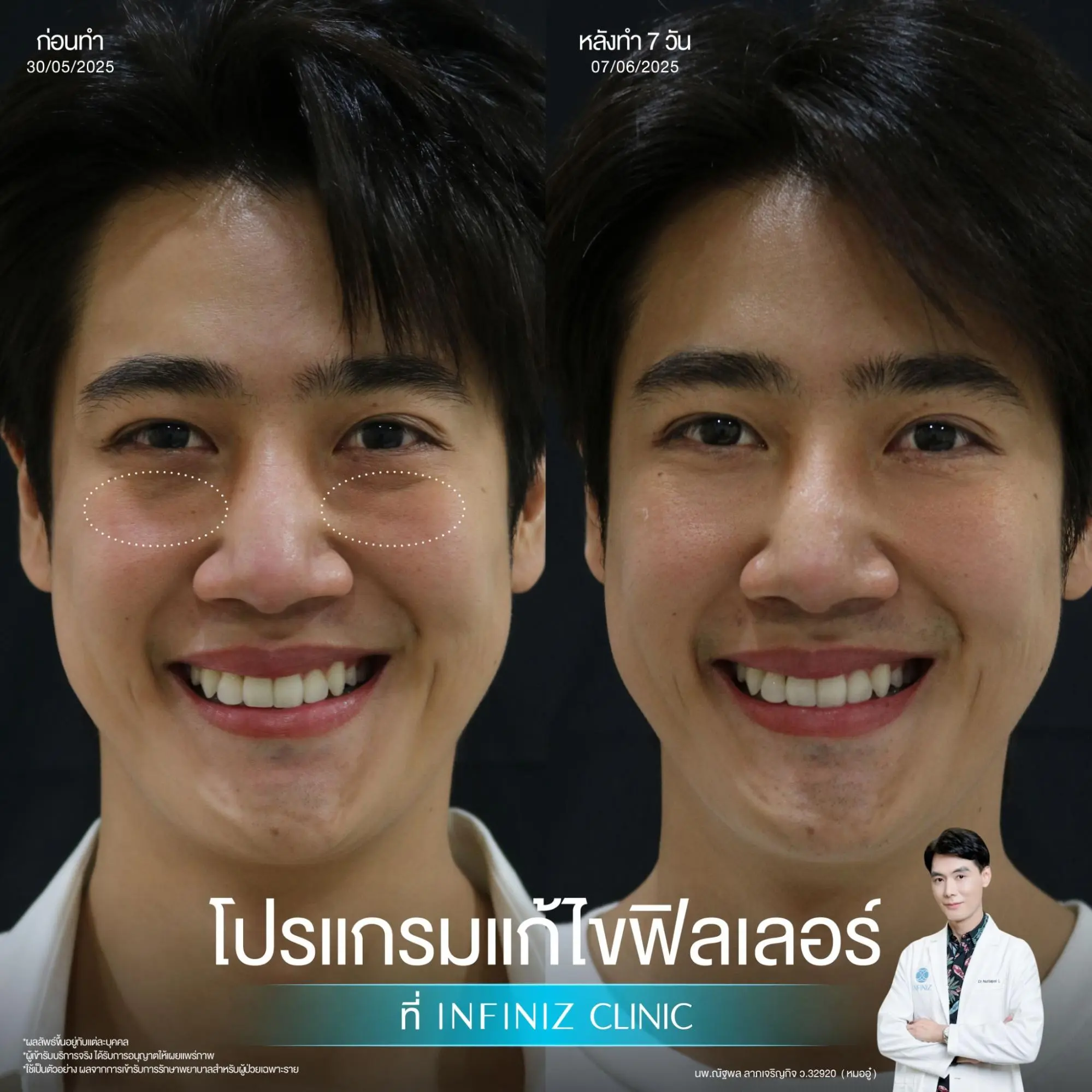 โปรแกรมสลายฟิลเลอร์อันตรายไหม