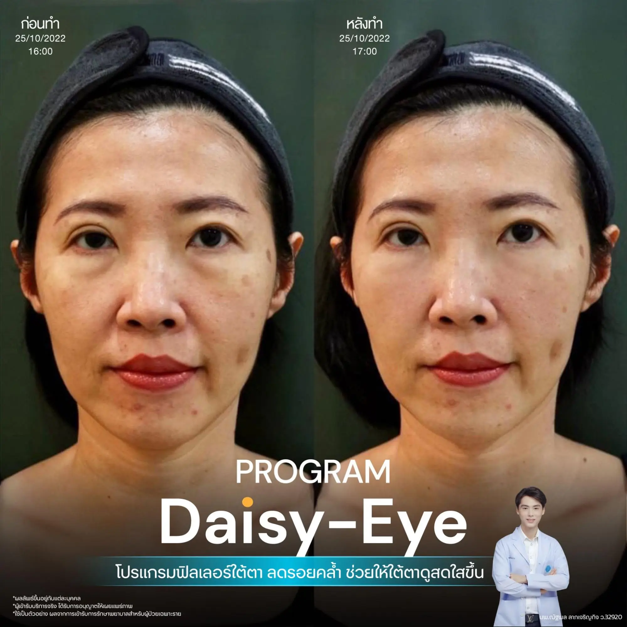 รีวิวโปรแกรมฟิลเลอร์ใต้ตา