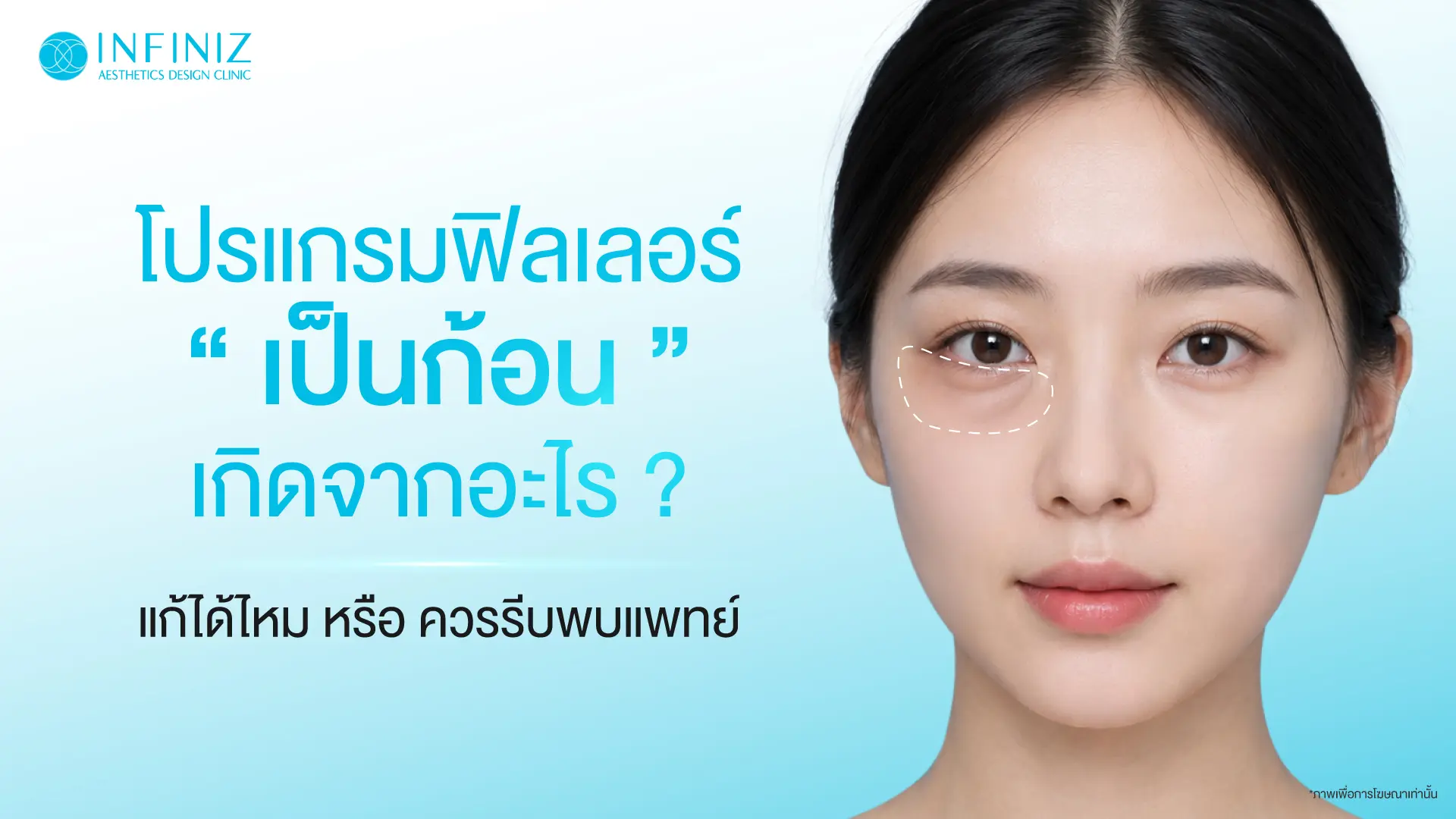 โปรแกรมฟิลเลอร์เป็นก้อน