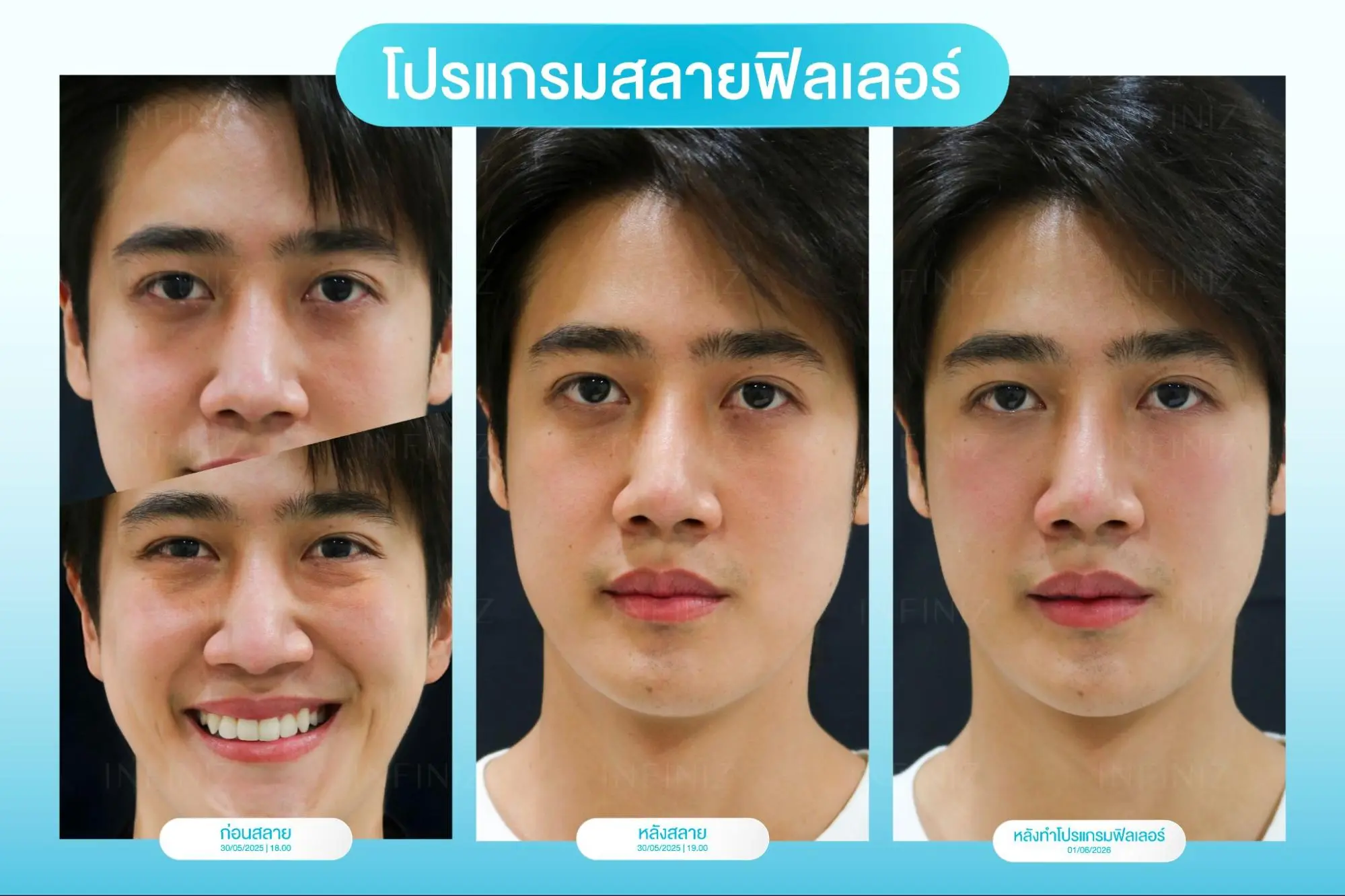 โปรแกรมสลายฟิลเลอร์กี่วันหาย? กู้หน้าเป็นก้อนนานแค่ไหน ให้กลับมั่นใจได้เหมือนเดิม 3 โปรแกรมฟิลเลอร์