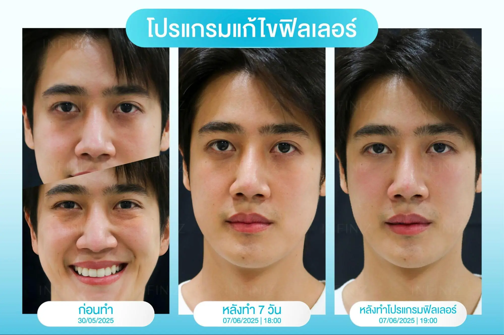 ทำโปรแกรมสลายฟิลเลอร์ใต้ตาแล้วต้องรอกี่วัน ถึงจะเห็นว่าเข้าที่?