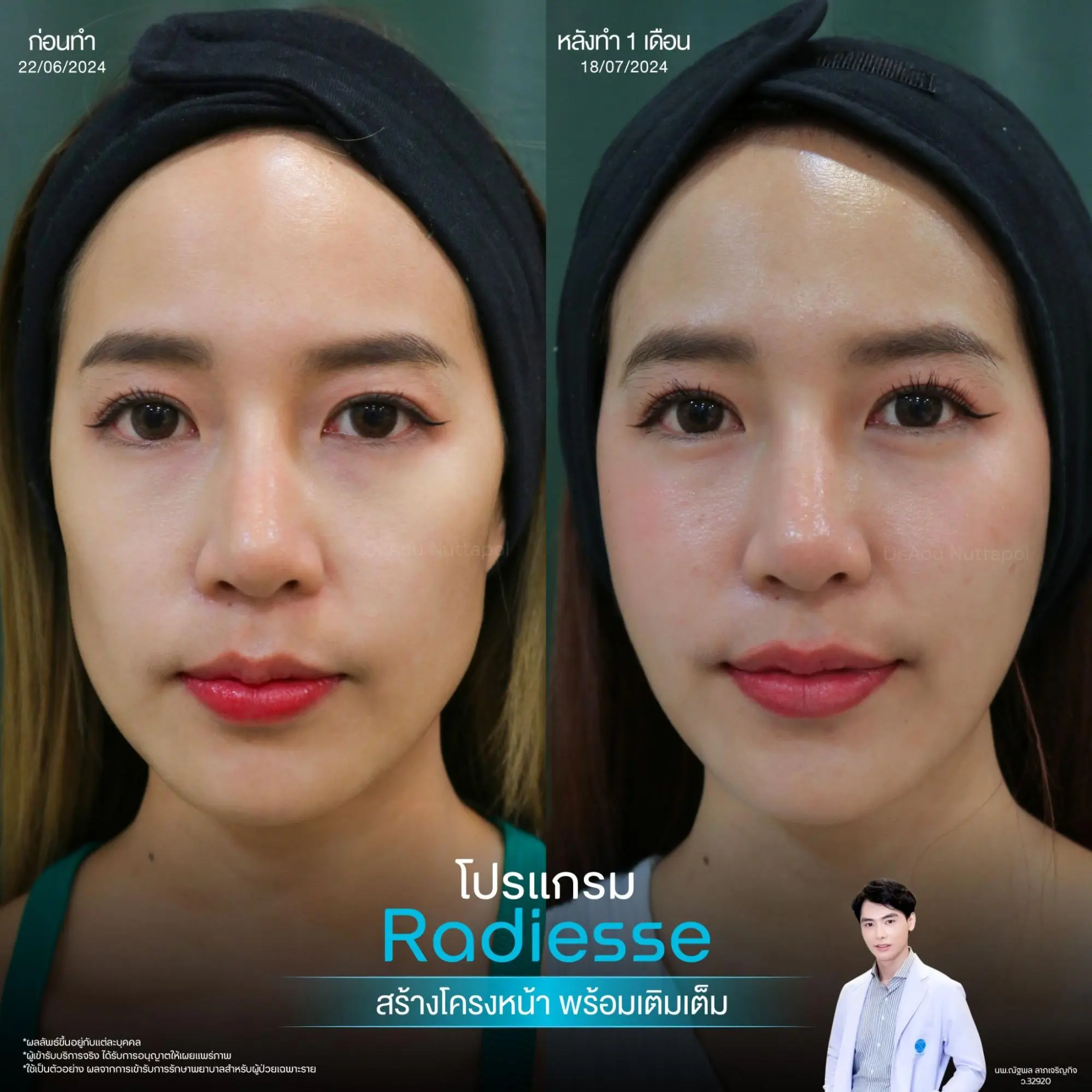 ยกกระชับผิวด้วย Radiesse