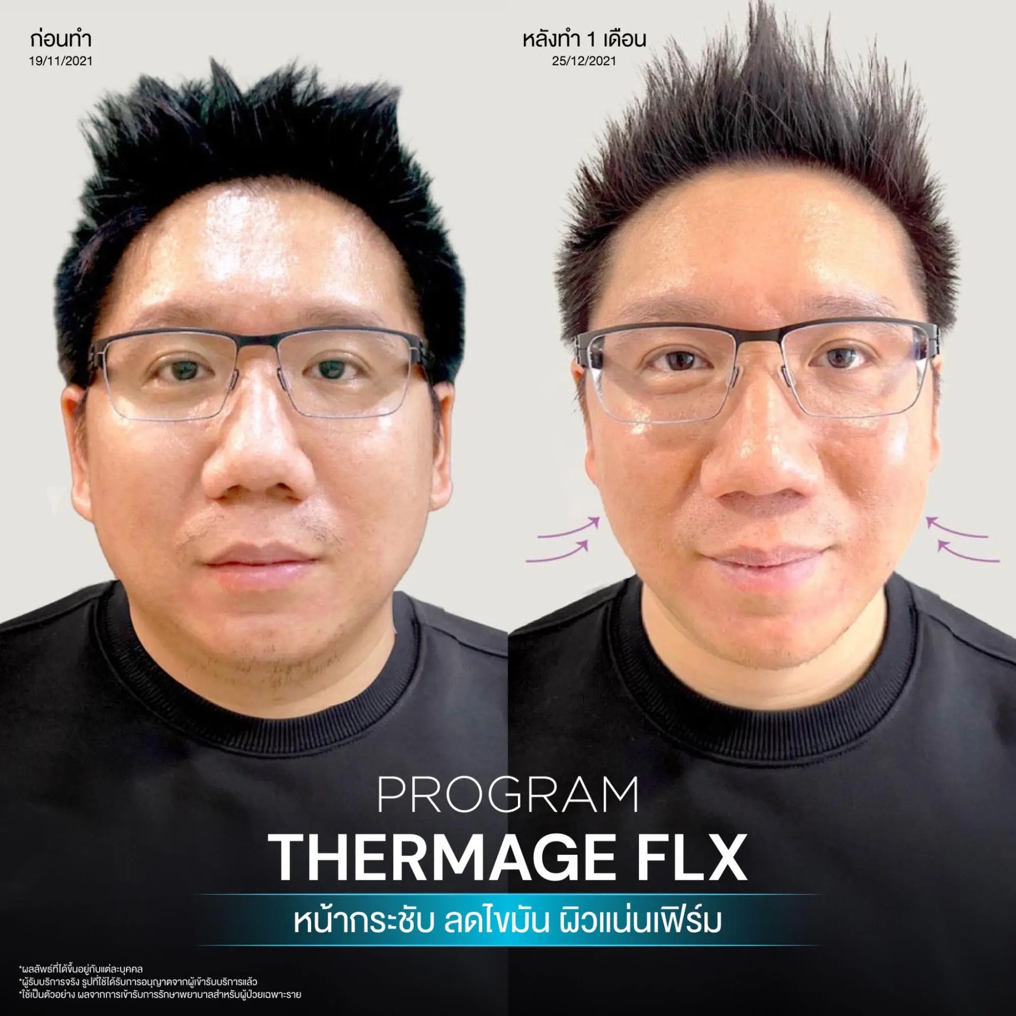 ยกกระชับผิวด้วย Thermage