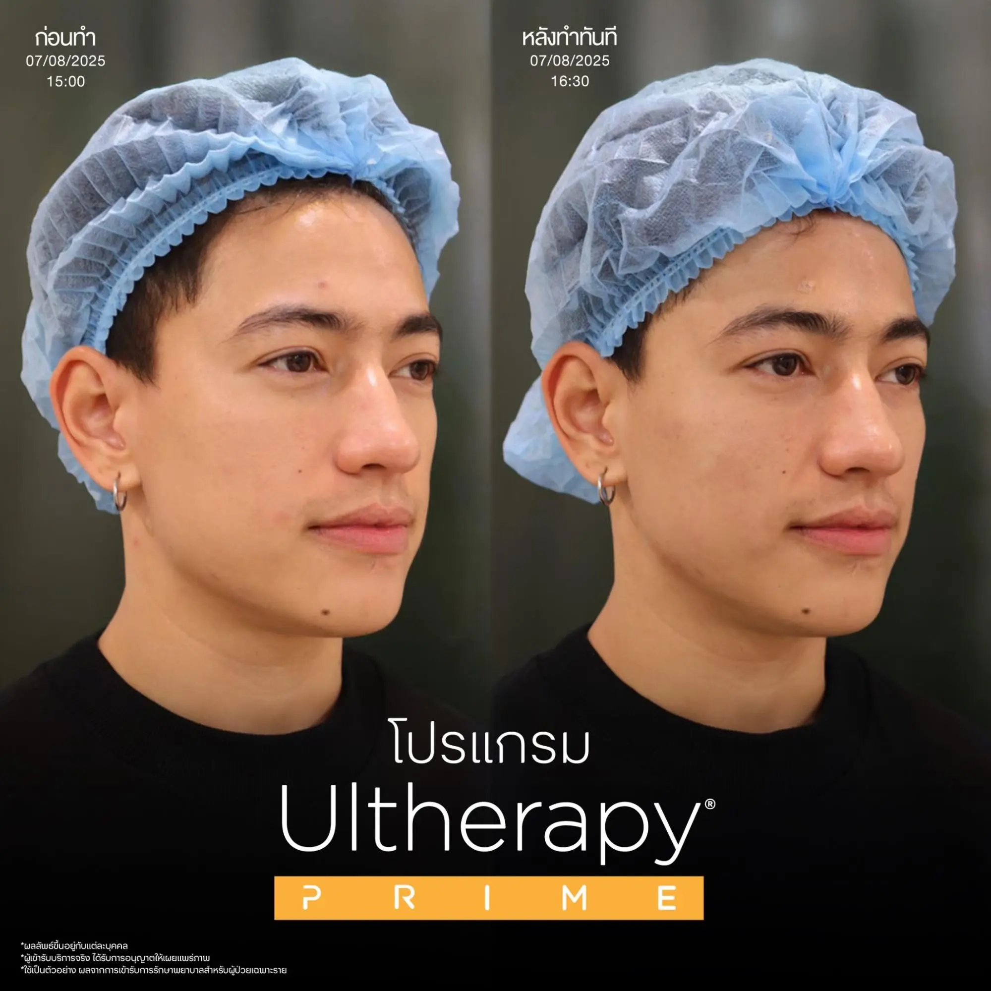 ยกกระชับผิวด้วย Ulthera