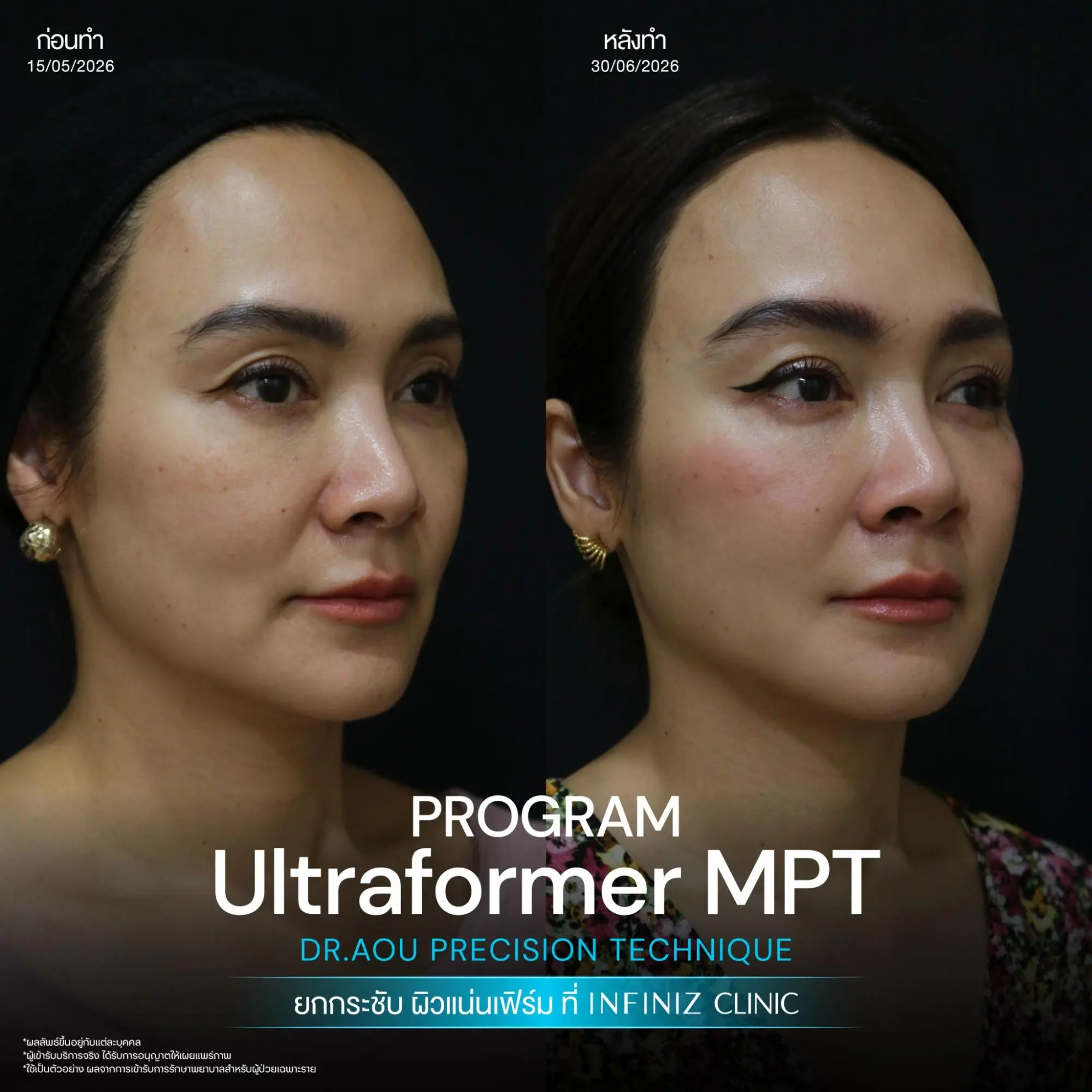 ยกกระชับผิวด้วย Ultraformer